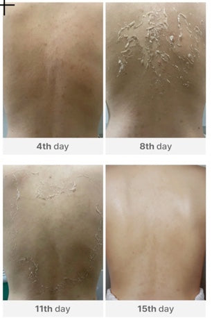 Medisco Peelieve Peeling Powder & Solution
